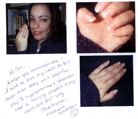 Testimonial Overcome Nail Biting with Hypnosis